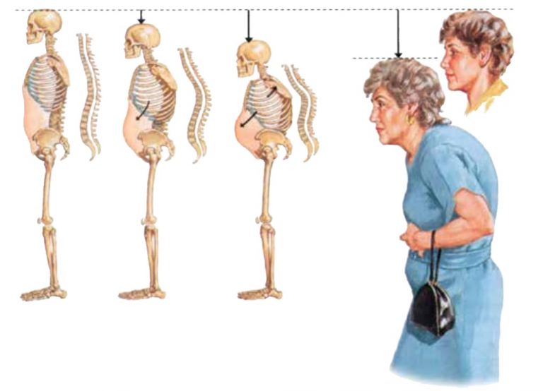 kako napreduje osteoporoza in znacilnosti osteoporoze