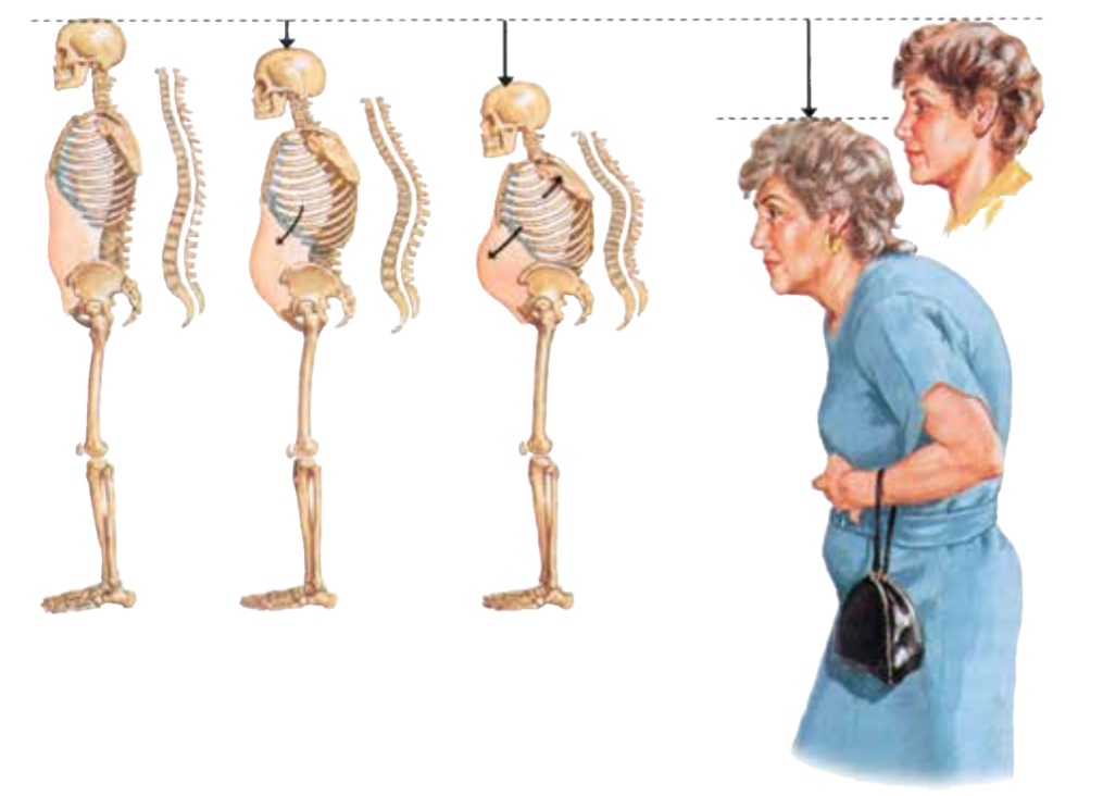 kako napreduje osteoporoza in znacilnosti osteoporoze